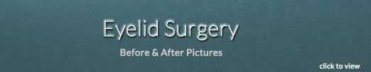 Blepharoplasty (Eyelid Surgery) in Virginia Beach, VA