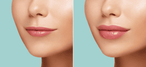 Lip Augmentation in Virginia Beach: Your Complete Guide to Plump, Beautiful Lips