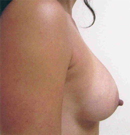 Breast Augmentation Before and After Pictures Virginia Beach, VA