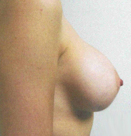 Breast Augmentation Before and After Pictures Virginia Beach, VA