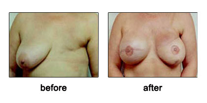 Breast Reconstruction Before and After Pictures Virginia Beach, VA